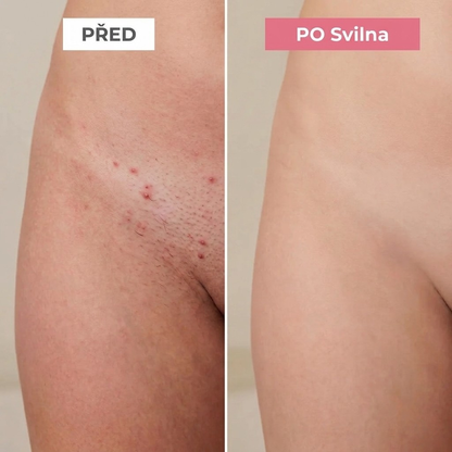 SVILNA | Jemné řešení pro všechny citlivé zóny