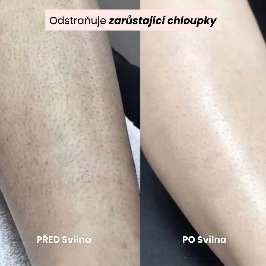 SVILNA | Jemné řešení pro všechny citlivé zóny